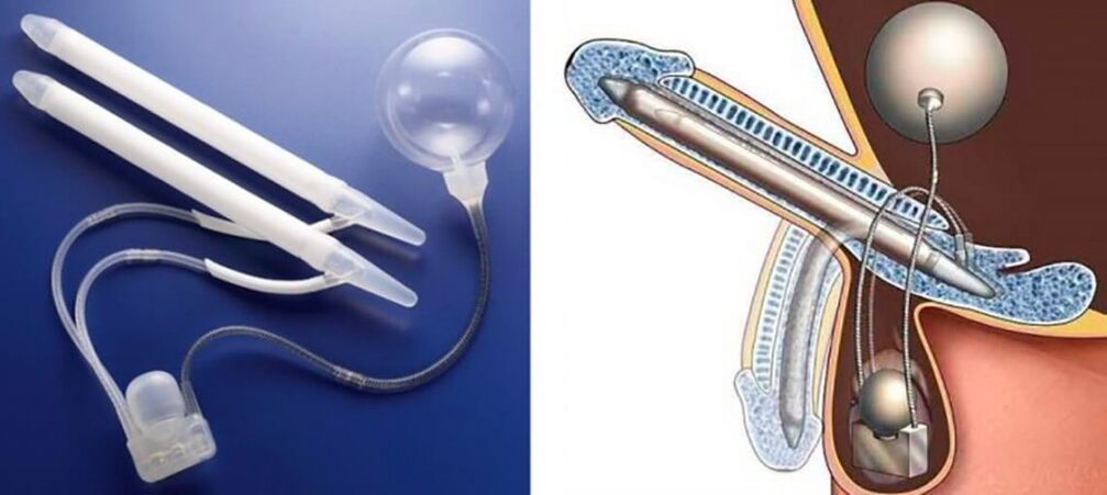 penile prosthesis para sa pagpapalaki ng titi